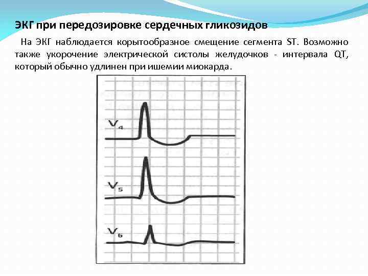 ЭКГ при передозировке сердечных гликозидов На ЭКГ наблюдается корытообразное смещение сегмента ST. Возможно также