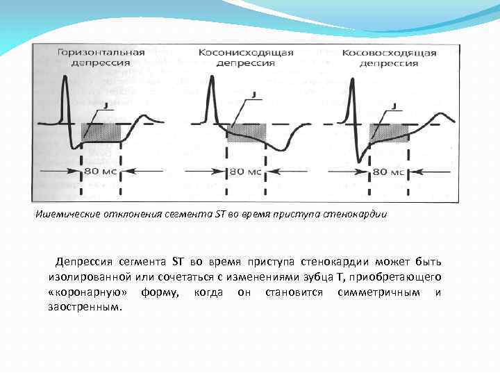 Ишемические отклонения сегмента SТ во время приступа стенокардии Депрессия сегмента ST во время приступа