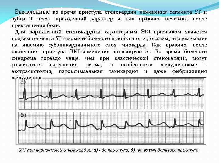 Выявленные во время приступа стенокардии изменения сегмента ST и зубца Т носят преходящий характер