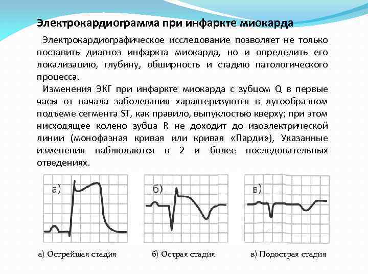 Электрокардиограмма при инфаркте миокарда Электрокардиографическое исследование позволяет не только поставить диагноз инфаркта миокарда, но
