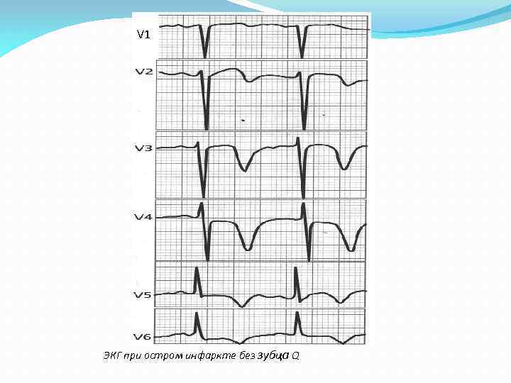 V 1 ЭКГ при остром инфаркте без зубца Q 