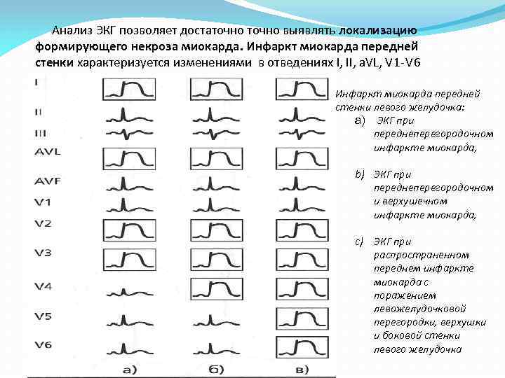 Анализ ЭКГ позволяет достаточно выявлять локализацию формирующего некроза миокарда. Инфаркт миокарда передней стенки характеризуется