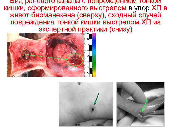 Вид раневого канала с повреждением тонкой кишки, сформированного выстрелом в упор ХП в живот