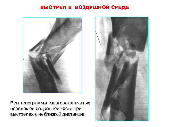 ВЫСТРЕЛ В ВОЗДУШНОЙ СРЕДЕ Рентгенограммы многооскольчатых переломов бедренной кости при выстрелах с неблизкой дистанции