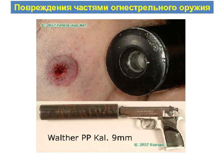 Повреждения частями огнестрельного оружия 
