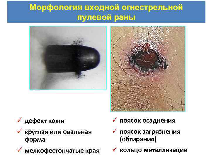 Морфология входной огнестрельной пулевой раны ü дефект кожи ü поясок осаднения ü круглая или