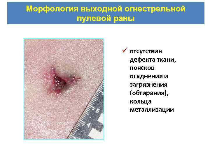 Морфология выходной огнестрельной пулевой раны ü отсутствие дефекта ткани, поясков осаднения и загрязнения (обтирания),