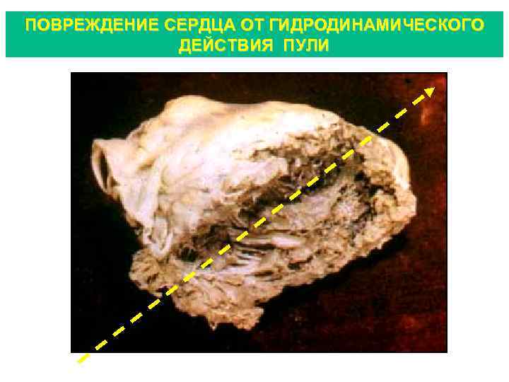 ПОВРЕЖДЕНИЕ СЕРДЦА ОТ ГИДРОДИНАМИЧЕСКОГО ДЕЙСТВИЯ ПУЛИ 