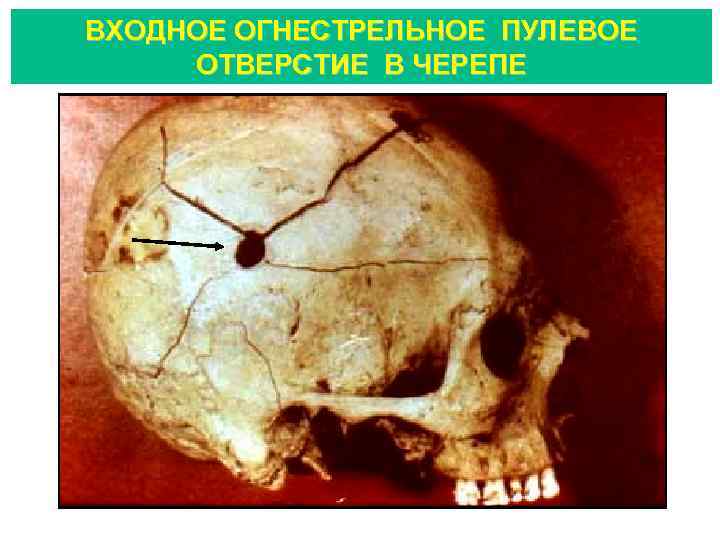 ВХОДНОЕ ОГНЕСТРЕЛЬНОЕ ПУЛЕВОЕ ОТВЕРСТИЕ В ЧЕРЕПЕ 