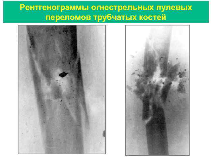 Рентгенограммы огнестрельных пулевых переломов трубчатых костей 