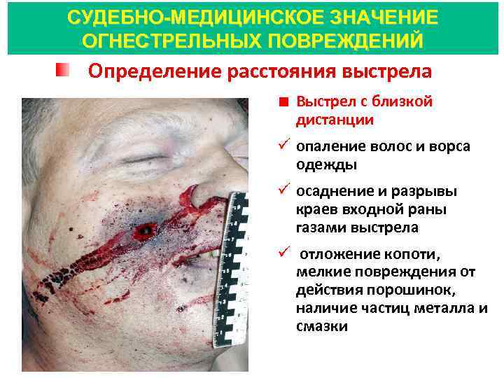 СУДЕБНО-МЕДИЦИНСКОЕ ЗНАЧЕНИЕ ОГНЕСТРЕЛЬНЫХ ПОВРЕЖДЕНИЙ Определение расстояния выстрела Выстрел с близкой дистанции ü опаление волос