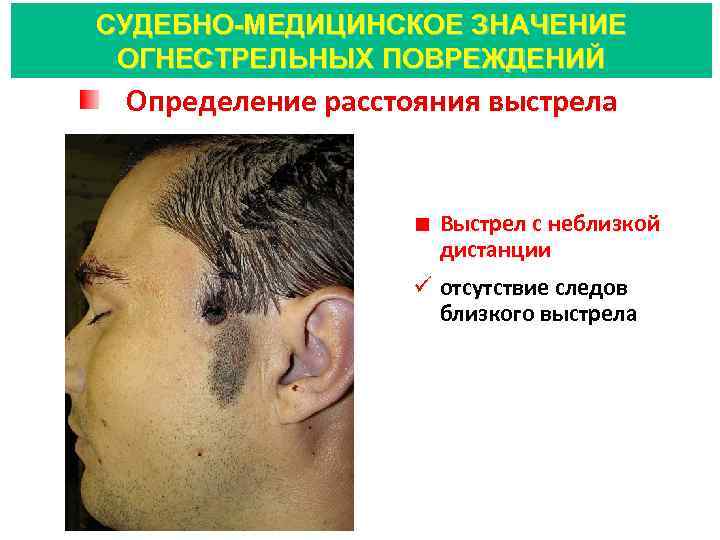 СУДЕБНО-МЕДИЦИНСКОЕ ЗНАЧЕНИЕ ОГНЕСТРЕЛЬНЫХ ПОВРЕЖДЕНИЙ Определение расстояния выстрела Выстрел с неблизкой дистанции ü отсутствие следов