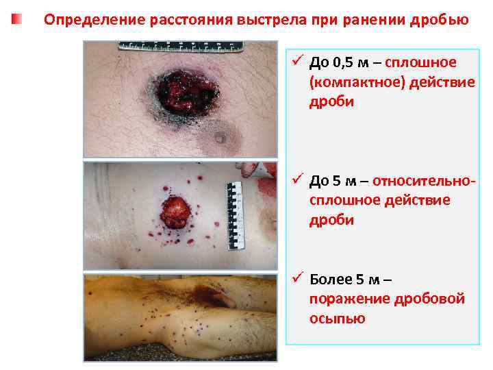 Определение расстояния выстрела при ранении дробью ü До 0, 5 м – сплошное (компактное)