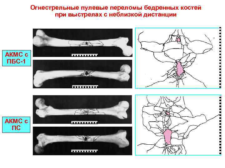 Карта вызова смп перелом бедренной кости