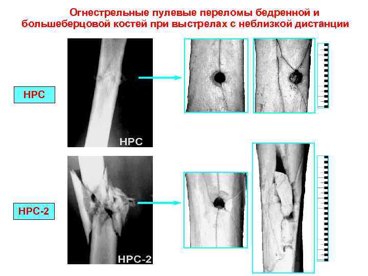 Огнестрельные пулевые переломы бедренной и большеберцовой костей при выстрелах с неблизкой дистанции НРС-2 