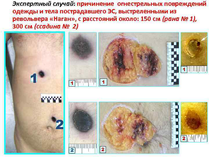 Экспертный случай: причинение огнестрельных повреждений одежды и тела пострадавшего ЭС, выстреленными из револьвера «Наган»