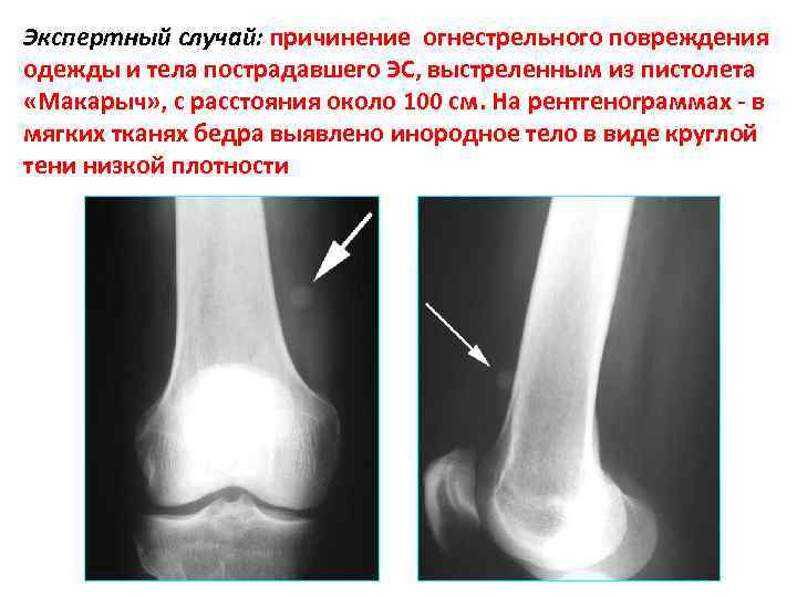 Экспертный случай: причинение огнестрельного повреждения одежды и тела пострадавшего ЭС, выстреленным из пистолета «Макарыч»