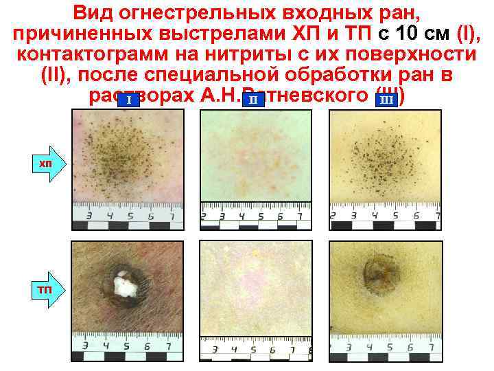 Вид огнестрельных входных ран, причиненных выстрелами ХП и ТП с 10 см (I), контактограмм