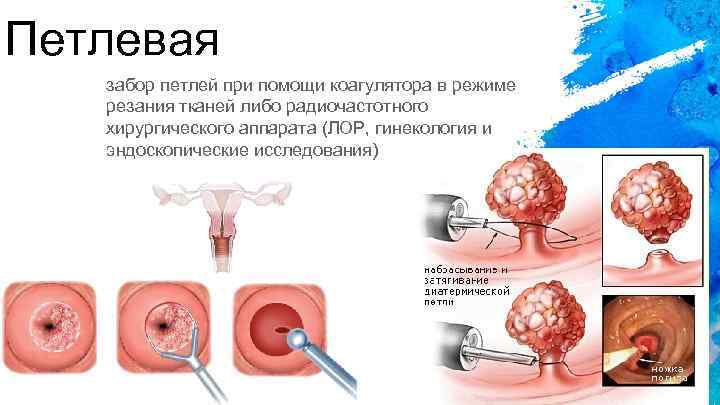 Петлевая забор петлей при помощи коагулятора в режиме резания тканей либо радиочастотного хирургического аппарата