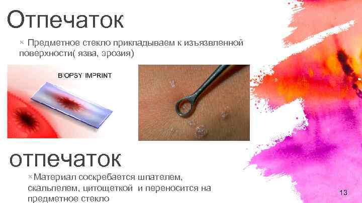 Отпечаток × Предметное стекло прикладываем к изъязвленной поверхности( язва, эрозия) Мазок отпечаток × Материал