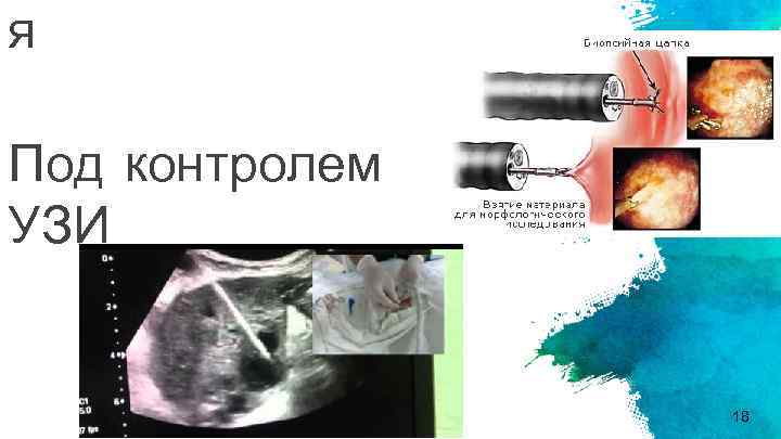 я Под контролем УЗИ 18 
