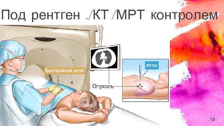 Под рентген. /КТ /МРТ контролем 19 