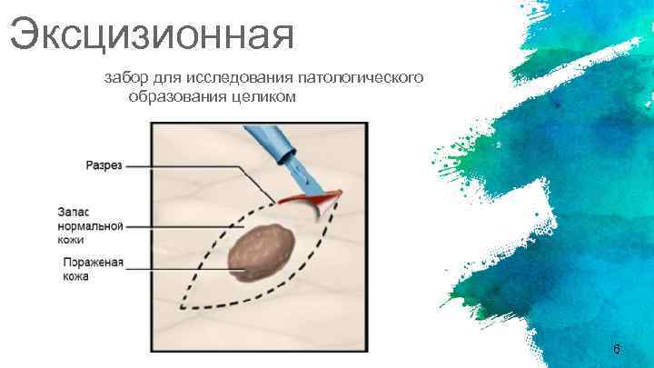 Эксцизионная забор для исследования патологического образования целиком 6 