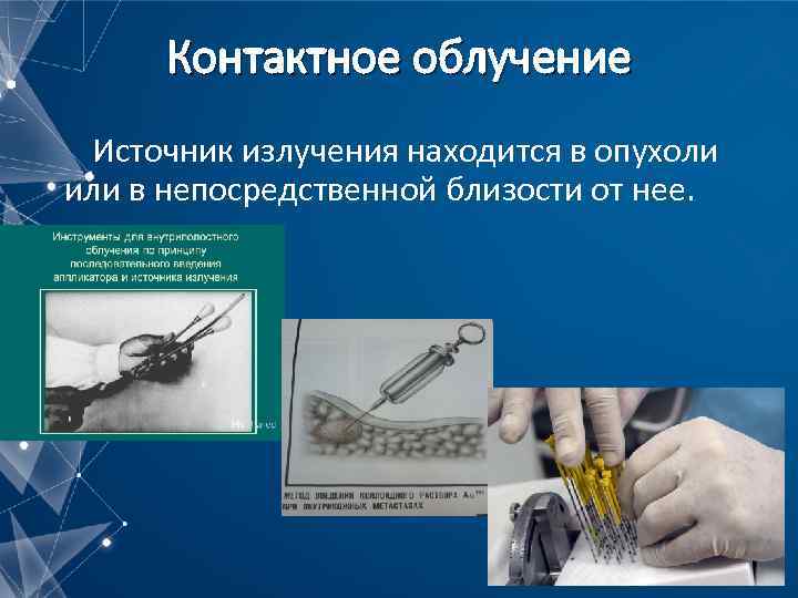 Контактное облучение Источник излучения находится в опухоли или в непосредственной близости от нее. 