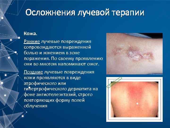 Осложнения лучевой терапии Кожа. Ранние лучевые повреждения сопровождаются выраженной болью и жжением в зоне