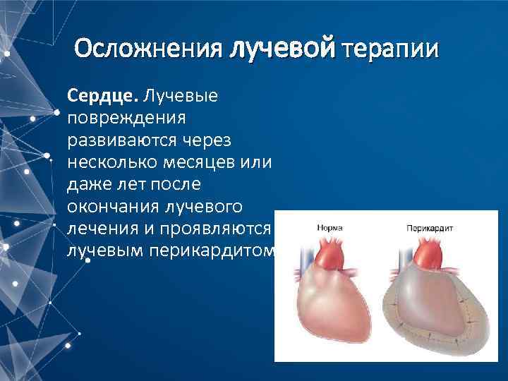 Осложнения лучевой терапии Сердце. Лучевые повреждения развиваются через несколько месяцев или даже лет после