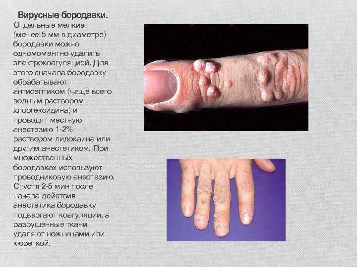 Вирусные бородавки. Отдельные мелкие (менее 5 мм в диаметре) бородавки можно одномоментно удалить электрокоагуляцией.