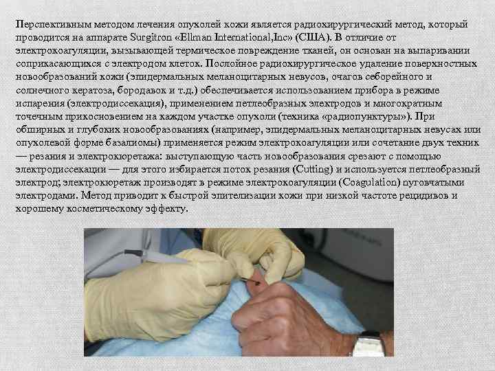 Перспективным методом лечения опухолей кожи является радиохирургический метод, который проводится на аппарате Surgitron «Ellman