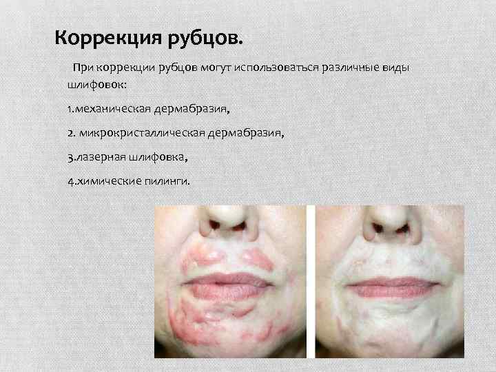 Коррекция рубцов. При коррекции рубцов могут использоваться различные виды шлифовок: 1. механическая дермабразия, 2.
