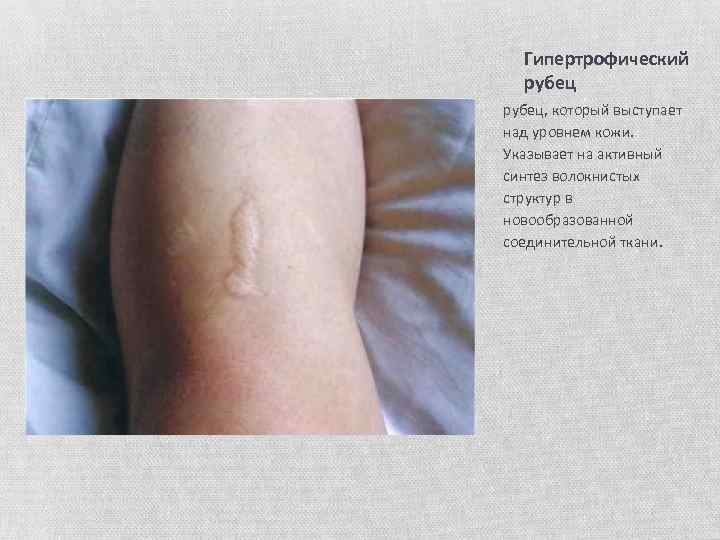 Гипертрофический рубец, который выступает над уровнем кожи. Указывает на активный синтез волокнистых структур в