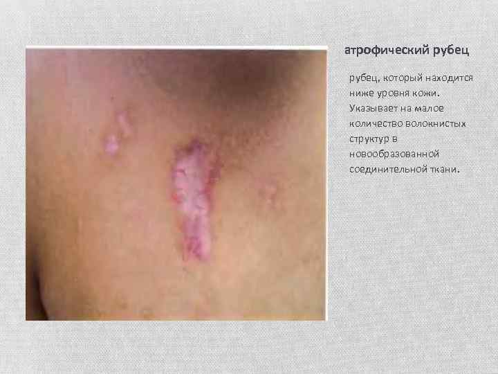атрофический рубец, который находится ниже уровня кожи. Указывает на малое количество волокнистых структур в