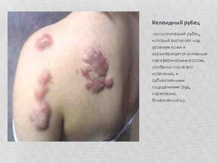 Келоидный рубец патологический рубец, который выступает над уровнем кожи и характеризуется активным периферическим ростом,