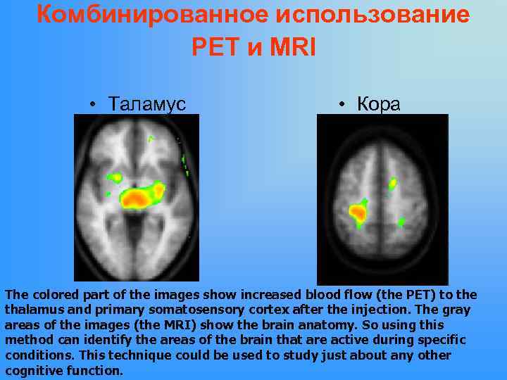 Комбинированное использование PET и MRI • Таламус • Кора The colored part of the