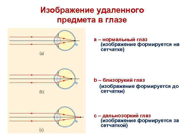 Изображение удаленного предмета в глазе a – нормальный глаз (изображение формируется на сетчатке) b