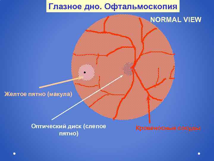 Глазное дно. Офтальмоскопия NORMAL VIEW Желтое пятно (макула) Оптический диск (слепое пятно) Кровеносные сосуды