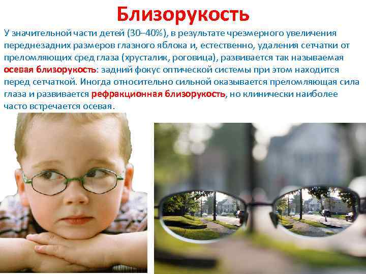 Близорукость У значительной части детей (30– 40%), в результате чрезмерного увеличения переднезадних размеров глазного