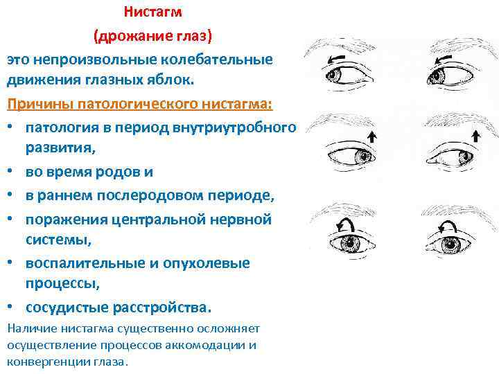 Нистагм (дрожание глаз) это непроизвольные колебательные движения глазных яблок. Причины патологического нистагма: • патология
