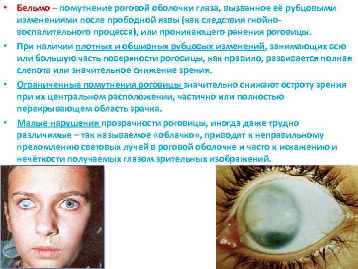  • Бельмо – помутнение роговой оболочки глаза, вызванное её рубцовыми изменениями после прободной