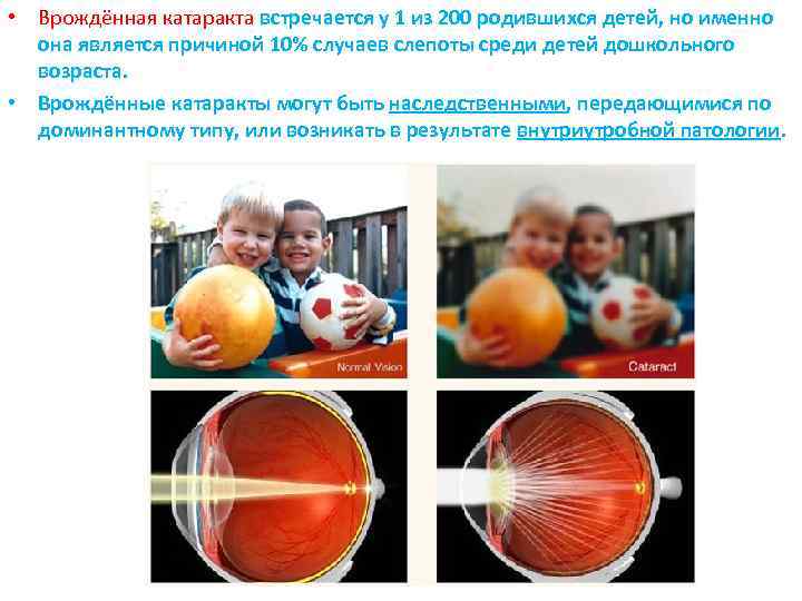  • Врождённая катаракта встречается у 1 из 200 родившихся детей, но именно она