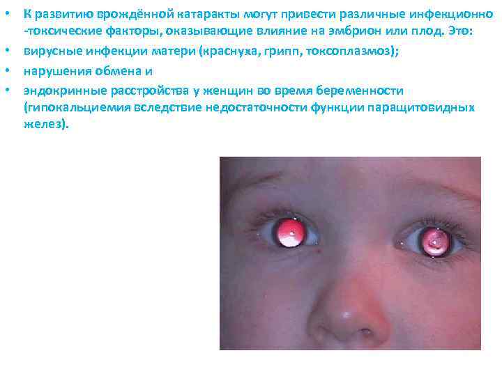 • К развитию врождённой катаракты могут привести различные инфекционно -токсические факторы, оказывающие влияние