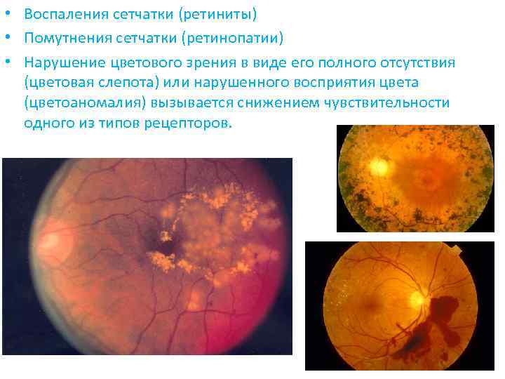  • Воспаления сетчатки (ретиниты) • Помутнения сетчатки (ретинопатии) • Нарушение цветового зрения в