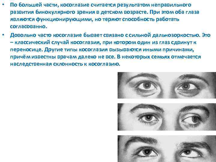  • По большей части, косоглазие считается результатом неправильного развития бинокулярного зрения в детском