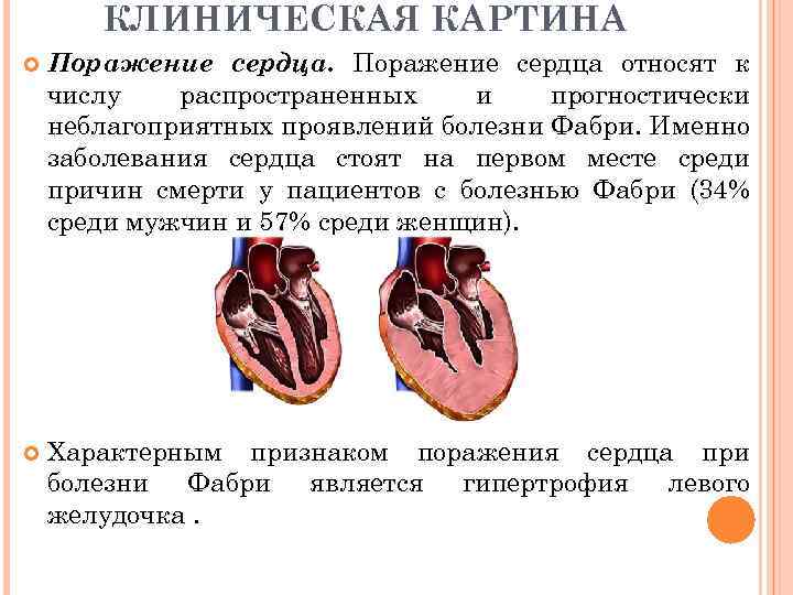 КЛИНИЧЕСКАЯ КАРТИНА Поражение сердца относят к числу распространенных и прогностически неблагоприятных проявлений болезни Фабри.