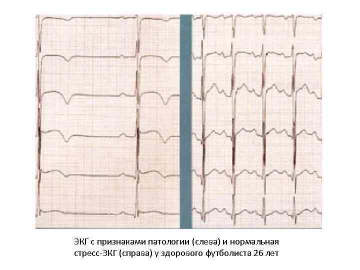 ЭКГ с признаками патологии (слева) и нормальная стресс-ЭКГ (справа) у здорового футболиста 26 лет