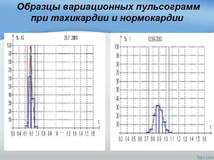  Образцы вариационных пульсограмм при тахикардии и нормокардии 