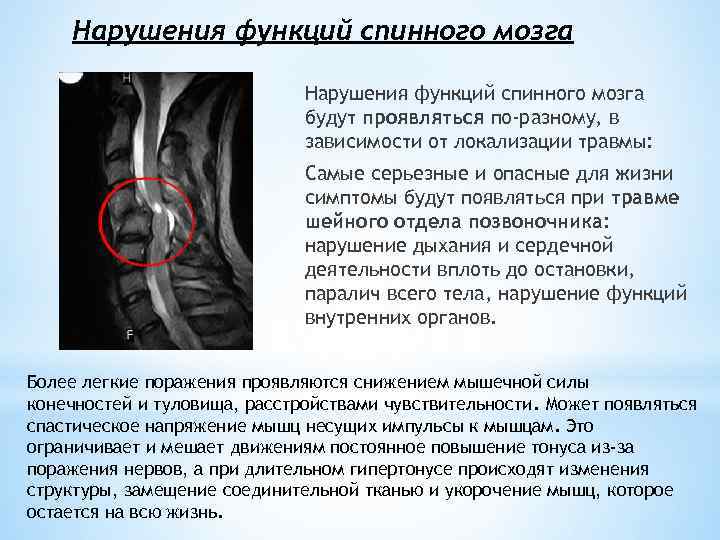 Нарушения функций спинного мозга будут проявляться по-разному, в зависимости от локализации травмы: Самые серьезные